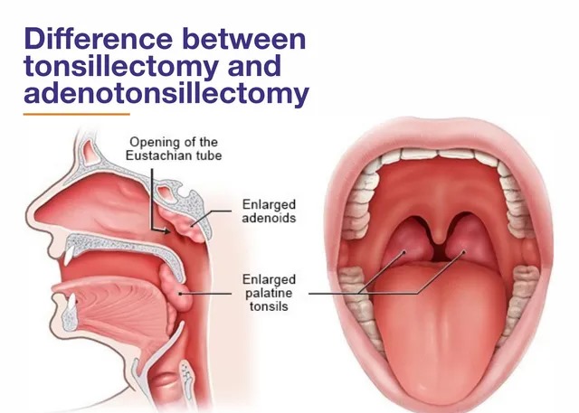 tonsils